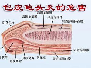 ⑶白色念珠菌性包皮龟头炎:在包皮龟头上可见红斑,表面光滑并