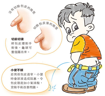 孩子出现要不要做割包皮呢