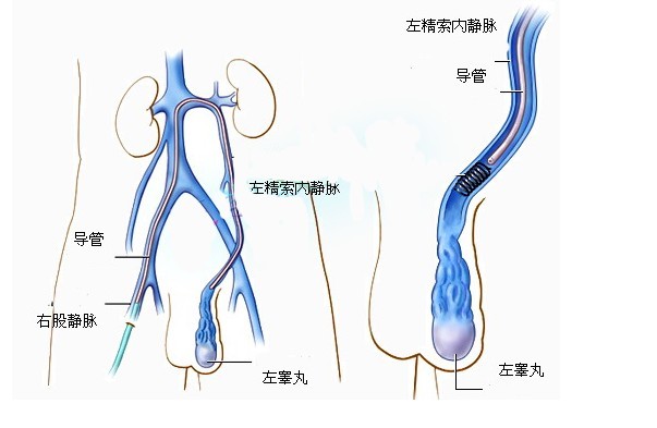 男性如何预防精索静脉曲张