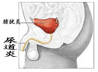 尿道炎给男性患者带来哪些危害