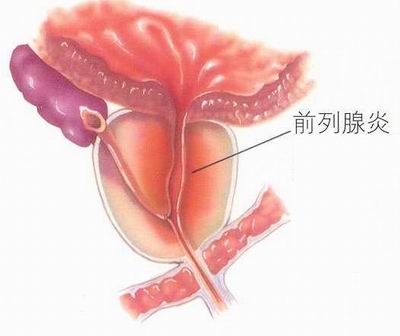 钦州前列腺炎的危害是什么