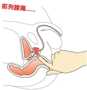 前列腺痛有什么症状