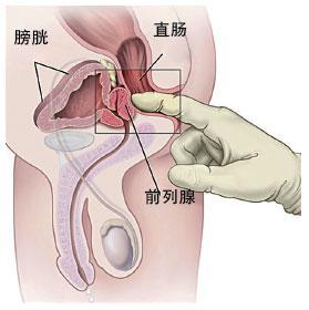 钦州桂大医院治疗前列腺炎好不好
