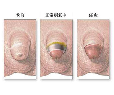 钦州桂大男科能割包皮吗