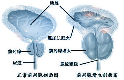 钦州男性前列腺增生的致病因素有哪些