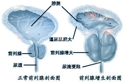 钦州男性男科检查增生的致病因素有哪些